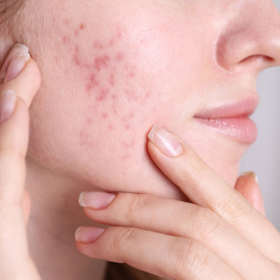 Acne Scars