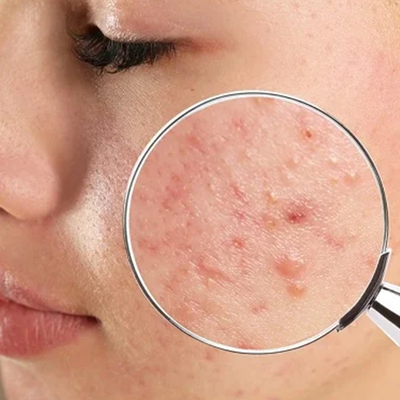Acne & pimples