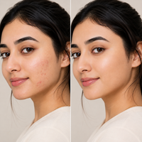 Anti Acne Treatment Kit
