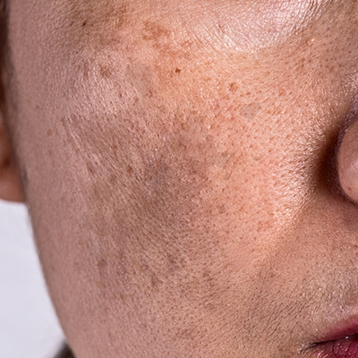 Pigmentation